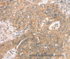 Immunohistochemistry of paraffin-embedded Human breast cancer using STX10 Polyclonal Antibody at dilution of 1:45