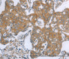 Immunohistochemistry of paraffin-embedded Human breast cancer using TNK2 Polyclonal Antibody at dilution of 1:70