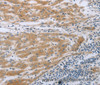 Immunohistochemistry of paraffin-embedded Human liver cancer using TNK2 Polyclonal Antibody at dilution of 1:70