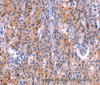 Immunohistochemistry of paraffin-embedded Human gastric cancer tissue using ADM2 Polyclonal Antibody at dilution 1:40