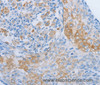 Immunohistochemistry of paraffin-embedded Human cervical cancer tissue using ADRB3 Polyclonal Antibody at dilution 1:60