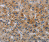 Immunohistochemistry of paraffin-embedded Human liver cancer tissue using IAPP Polyclonal Antibody at dilution 1:40