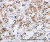 Immunohistochemistry of paraffin-embedded Human thyroid cancer tissue using IAPP Polyclonal Antibody at dilution 1:40