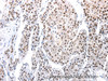 Immunohistochemistry of paraffin-embedded Human liver cancer tissue using AQP2 Polyclonal Antibody at dilution 1:100