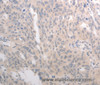 Immunohistochemistry of paraffin-embedded Human ovarian cancer tissue using CD275 Polyclonal Antibody at dilution 1:30