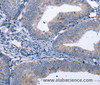 Immunohistochemistry of paraffin-embedded Human cervical cancer tissue using BDNF Polyclonal Antibody at dilution 1:40