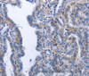 Immunohistochemistry of paraffin-embedded Human thyroid cancer tissue using BDNF Polyclonal Antibody at dilution 1:40