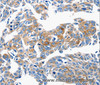 Immunohistochemistry of paraffin-embedded Human lung cancer tissue using CCL6 Polyclonal Antibody at dilution 1:50