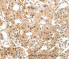 Immunohistochemistry of paraffin-embedded Human breast cancer tissue using COL4A1 Polyclonal Antibody at dilution 1:30