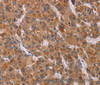 Immunohistochemistry of paraffin-embedded Human liver cancer tissue using CALCA Polyclonal Antibody at dilution 1:40