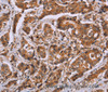 Immunohistochemistry of paraffin-embedded Human breast cancer tissue using CALCA Polyclonal Antibody at dilution 1:40