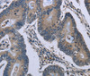 Immunohistochemistry of paraffin-embedded Human colon cancer tissue using Connexin 47 Polyclonal Antibody at dilution 1:40