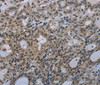 Immunohistochemistry of paraffin-embedded Human thyroid cancer tissue using Connexin 47 Polyclonal Antibody at dilution 1:40