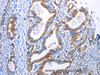 Immunohistochemistry of paraffin-embedded Human gastric cancer using DRD4 Polyclonal Antibody at dilution of 1:30