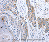 Immunohistochemistry of paraffin-embedded Human esophagus cancer tissue using NDUFA12 Polyclonal Antibody at dilution 1:50