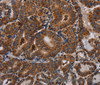 Immunohistochemistry of paraffin-embedded Human thyroid cancer tissue using DISC1 Polyclonal Antibody at dilution 1:30