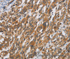 Immunohistochemistry of paraffin-embedded Human esophagus cancer tissue using DSP Polyclonal Antibody at dilution 1:40