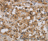Immunohistochemistry of paraffin-embedded Human thyroid cancer tissue using E2F4 Polyclonal Antibody at dilution 1:40