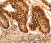 Immunohistochemistry of paraffin-embedded Human colon cancer tissue using E2F7 Polyclonal Antibody at dilution 1:60