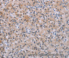 Immunohistochemistry of paraffin-embedded Human prostate cancer using SLC1A6 Polyclonal Antibody at dilution of 1:40