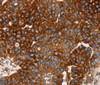 Immunohistochemistry of paraffin-embedded Human breast cancer tissue using EDAR Polyclonal Antibody at dilution 1:45