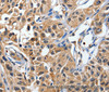 Immunohistochemistry of paraffin-embedded Human lung cancer tissue using DUSP8 Polyclonal Antibody at dilution 1:40