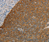 Immunohistochemistry of paraffin-embedded Human cervical cancer using FOXF2 Polyclonal Antibody at dilution of 1:30