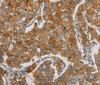 Immunohistochemistry of paraffin-embedded Human breast cancer using FOXF2 Polyclonal Antibody at dilution of 1:30