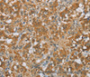 Immunohistochemistry of paraffin-embedded Human thyroid cancer tissue using FOXB1 Polyclonal Antibody at dilution 1:30