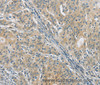 Immunohistochemistry of paraffin-embedded Human gasrtic cancer tissue using PKD1 Polyclonal Antibody at dilution 1:40