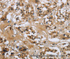 Immunohistochemistry of paraffin-embedded Human thyroid cancer tissue using LGALS7 Polyclonal Antibody at dilution 1:50