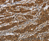 Immunohistochemistry of paraffin-embedded Human gasrtic cancer tissue using GATA5 Polyclonal Antibody at dilution 1:50