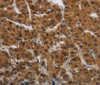 Immunohistochemistry of paraffin-embedded Human liver cancer tissue using GATA5 Polyclonal Antibody at dilution 1:50
