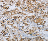 Immunohistochemistry of paraffin-embedded Human thyroid cancer tissue using CMTM8 Polyclonal Antibody at dilution 1:40