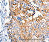 Immunohistochemistry of paraffin-embedded Human cervical cancer using Claudin 1 Polyclonal Antibody at dilution of 1:150