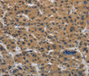 Immunohistochemistry of paraffin-embedded Human liver cancer tissue using Claudin 2 Polyclonal Antibody at dilution 1:50