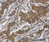Immunohistochemistry of paraffin-embedded Human gastric cancer tissue using Claudin 8 Polyclonal Antibody at dilution 1:50