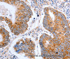 Immunohistochemistry of paraffin-embedded Human colon cancer tissue using Claudin 10 Polyclonal Antibody at dilution 1:50