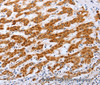 Immunohistochemistry of paraffin-embedded Human liver cancer tissue using Claudin 10 Polyclonal Antibody at dilution 1:50