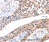 Immunohistochemistry of paraffin-embedded Human esophagus cancer tissue using Connexin-26 Polyclonal Antibody at dilution 1:100