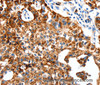 Immunohistochemistry of paraffin-embedded Human lung cancer using GLUT-1 Polyclonal Antibody at dilution of 1:50