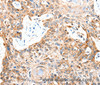 Immunohistochemistry of paraffin-embedded Human esophagus cancer using GLUT-1 Polyclonal Antibody at dilution of 1:50