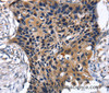 Immunohistochemistry of paraffin-embedded Human esophagus cancer tissue using SLC2A2 Polyclonal Antibody at dilution 1:35