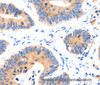 Immunohistochemistry of paraffin-embedded Human colon cancer tissue using GLUT-4 Polyclonal Antibody at dilution 1:70