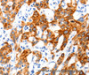 Immunohistochemistry of paraffin-embedded Human lung cancer tissue using SLC2A11 Polyclonal Antibody at dilution 1:140