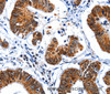 Immunohistochemistry of paraffin-embedded Human colon cancer tissue using GSK3 alpha Polyclonal Antibody at dilution 1:50