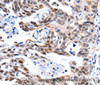 Immunohistochemistry of paraffin-embedded Human ovarian cancer tissue using GSK3 alpha Polyclonal Antibody at dilution 1:50