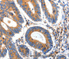 Immunohistochemistry of paraffin-embedded Human colon cancer tissue using IGFBP7 Polyclonal Antibody at dilution 1:50