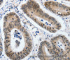 Immunohistochemistry of paraffin-embedded Human colon cancer using KLF5 Polyclonal Antibody at dilution of 1:120