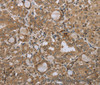 Immunohistochemistry of paraffin-embedded Human thyroid cancer tissue using STMN2/3/4 Polyclonal Antibody at dilution 1:45